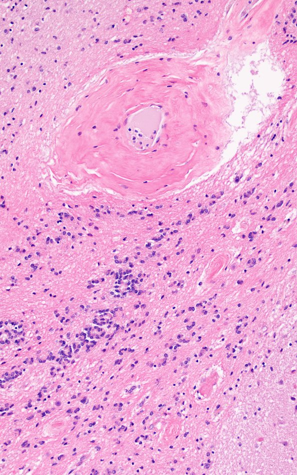 7A4 Basal Ganglia Ependymal Seam (Case 9) N2 H&E 5