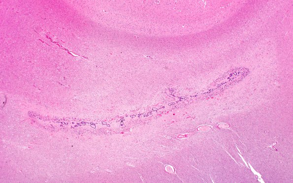 8A1 Ependymal Seam (Case 10) N5 H&E 2X A