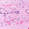 8A3 Ependymal Seam (A23-83, Case 10) N5 H&E 20X A