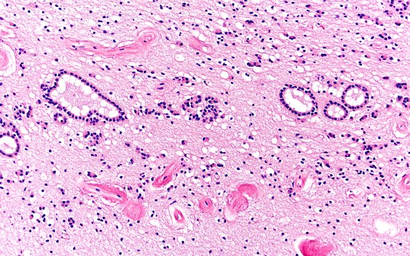8A3 Ependymal Seam (Case 10) N5 H&E 20X A