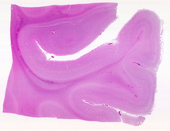 9A1 Ependymal Seam (Case 11) H&E N11 WM