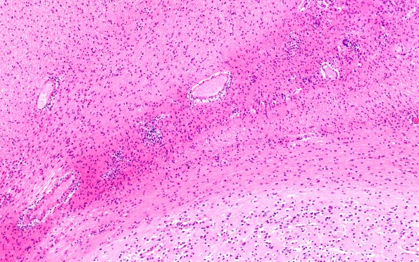 9A3 Ependymal Seam (Case 11) H&E N11 10X