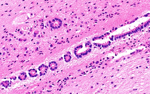 9A5 Ependymal Seam (Case 11) H&E N11 40X 2