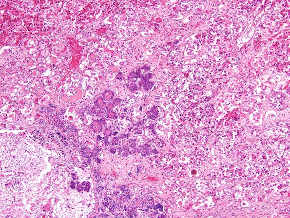 2A1 Erdheim rests, pituitary (Case 2) H&E 2.