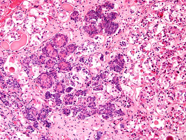 2A2 Erdheim rests, pituitary (Case 2) H&E 1