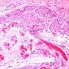 3 Erdheim rests, pituitary stalk (Case 3) H&E