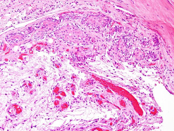 3 Erdheim rests, pituitary stalk (Case 3) H&E