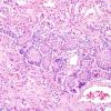 4A2 Pituitary, normal Hering Bodies and Erdheim rests (Case 4) H&E 3