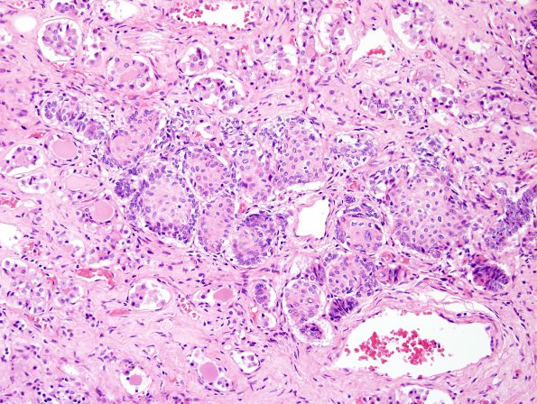 4A2 Pituitary, normal Hering Bodies and Erdheim rests (Case 4) H&E 3