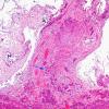 6A1Pituitary, Erdheim rests (Case 6) H&E 3 copy