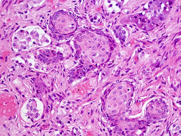 6A2 Pituitary, Erdheim rests (Case 6) H&E 2