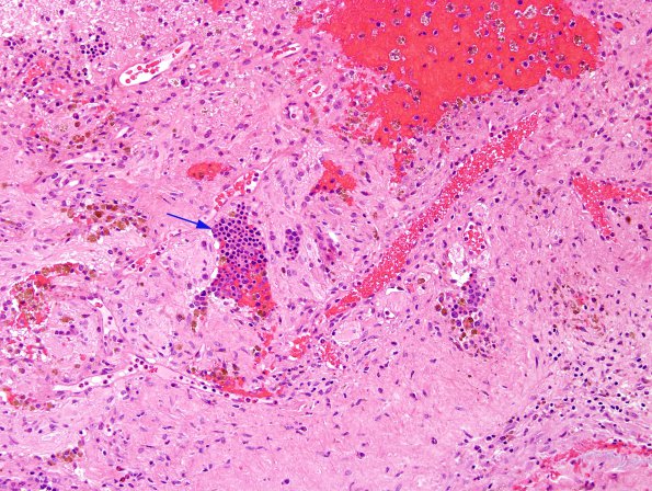 1A1 Extramedullary Hematopoiesis (EMH, Case 1) H&E 1