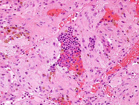 1A2 Extramedullary Hematopoiesis (EMH, Case 1) H&E 2