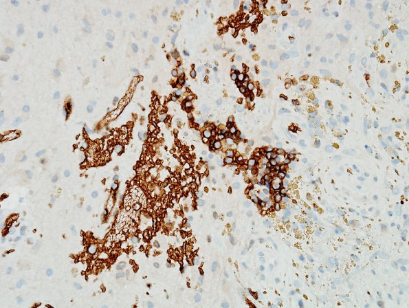 1A3 Extramedullary Hematopoiesis (EMH, Case 1) Glycophorin A 2