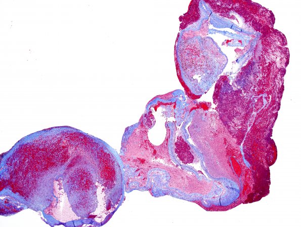 1A5 Extramedullary Hematopoiesis (EMH, Case 1) Trichrome 1