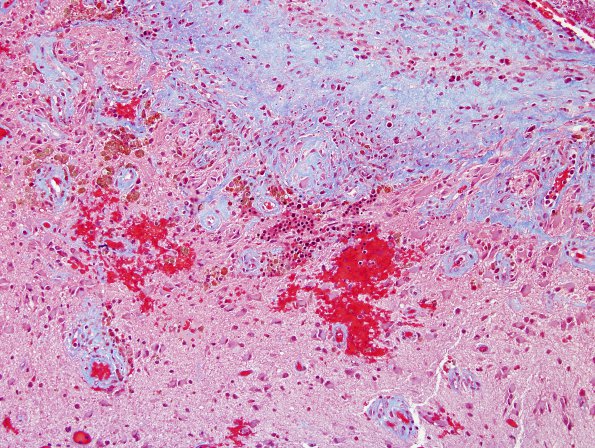 1A6 Extramedullary Hematopoiesis (EMH, Case 1) Trichrome 2