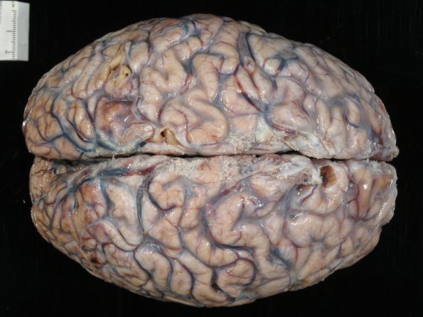 1A1 Fibrosis, leptomeningeal (Case 5) 1