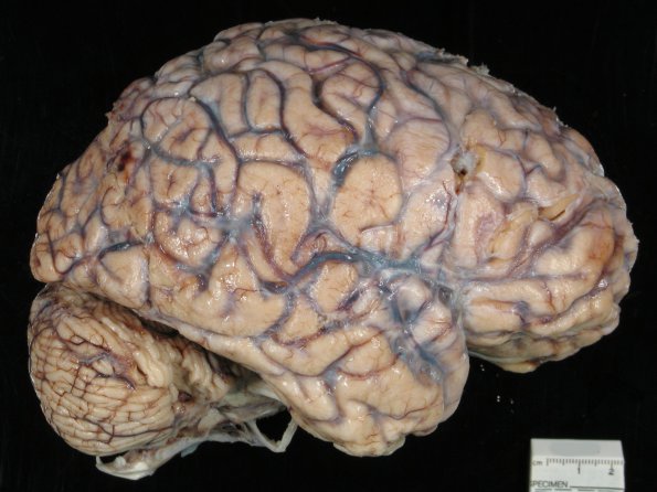 1A2 Fibrosis, leptomeningeal (Case 5) 2