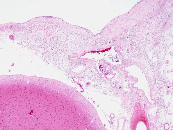 1A3 Fibrosis, parasaggital (Case 5) H&E 2