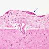 2A1 Fibrosis, leptomeningeal, parasagittal (Case 1) H&E 2