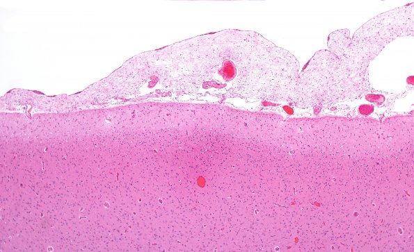 2A2 Fibrosis, leptomeningeal, parasaggital (Case 1) H&E 3
