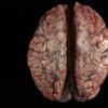 3A1 Fibrosis, leptomeningeal, perisaggital (Case 4) 2