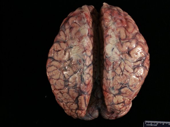 3A1 Fibrosis, leptomeningeal, perisaggital (Case 4) 2