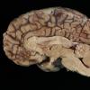 3A2 Fibrosis, leptomeningeal, perisaggital (Case 4) 5