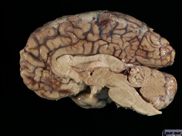 3A2 Fibrosis, leptomeningeal, perisaggital (Case 4) 5