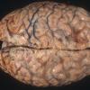 4A1 Fibrosis, leptomeningeal, perisaggital (Case 7) 1