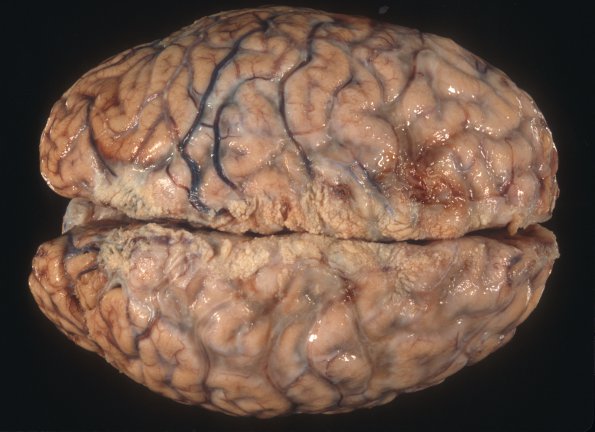 4A1 Fibrosis, leptomeningeal, perisaggital (Case 7) 1