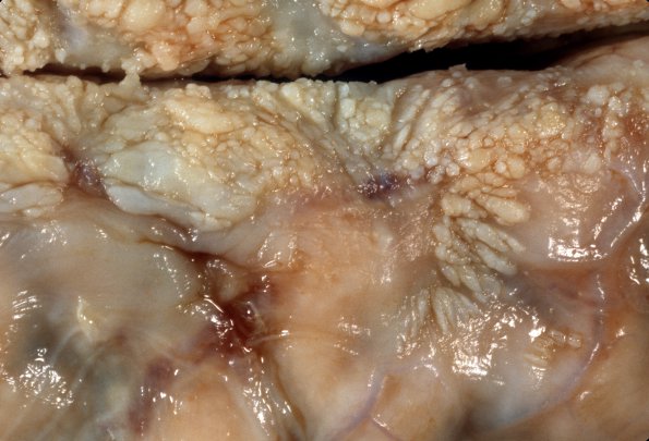 4A2 Fibrosis, leptomeningeal, perisaggital (Case 7) 2