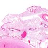 5 Fibrosis, leptomeningeal, parasagittal (Case 2) H&E 2