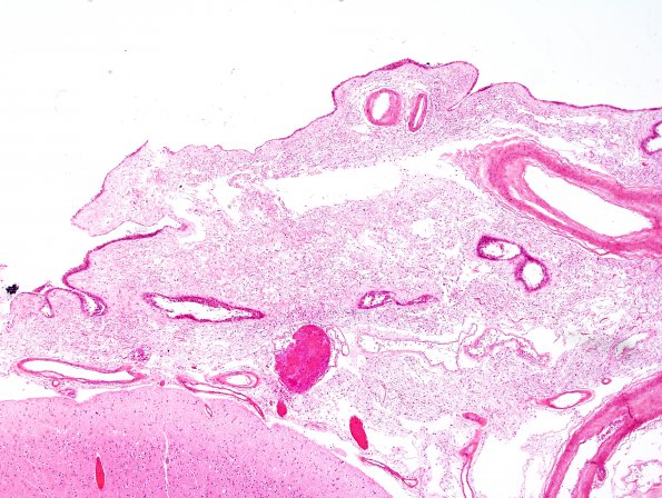 5 Fibrosis, leptomeningeal, parasagittal (Case 2) H&E 2