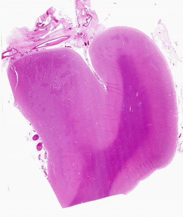 6 Fibrosis, leptomeningeal, parasaggital (Case 3) H&E 1 whole mount