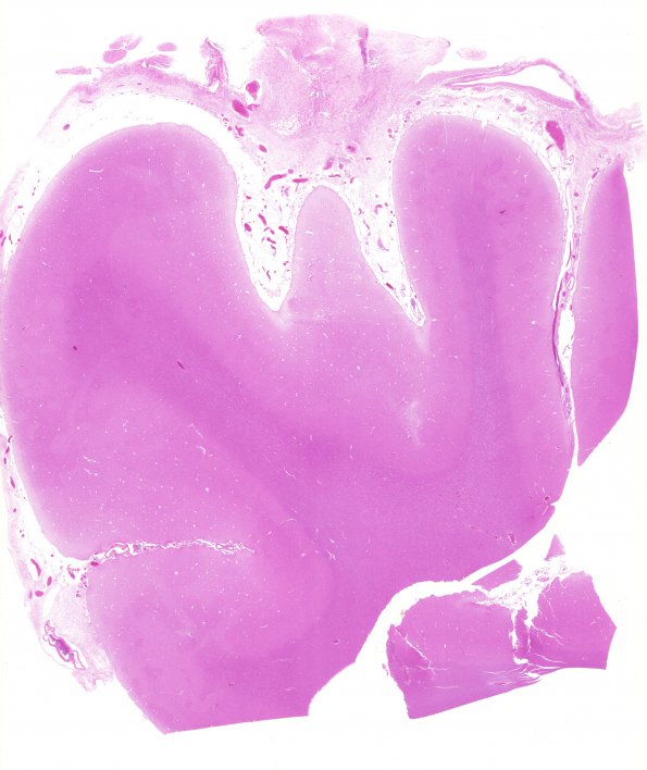 7A1 Perisagittal fibrosis leptomeningitis mimic (Case 10) H&E 1