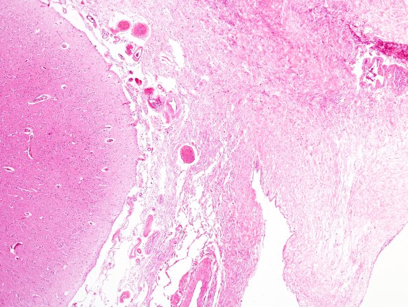 7A2 Perisaggital fibrosis leptomeningitis mimic (Case 10) H&E 2A