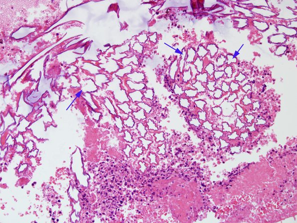 10 Surgical material (Case 10) H&E 1