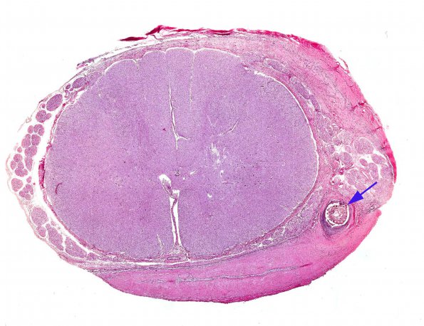 1A1 Foreign body (broomstraw, AANP 1960, Case 1) X1