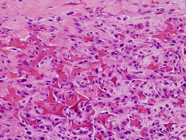 2 Foreign body reaction (Case 2) H&E 3