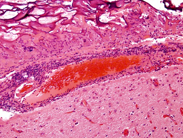 6A2 Foreign body Rxn (Gelfoam, Case 5) H&E 2