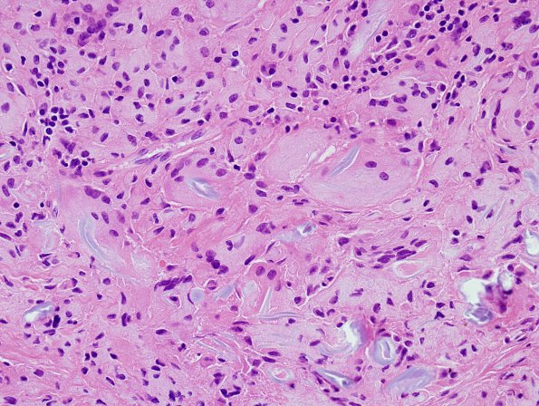 7A1 Foreign Body Rxn (surgical material, Case 6) H&E 6