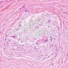 8A1 Foreign Body Rxn, suture (Case 7) H&E 3 non-pol