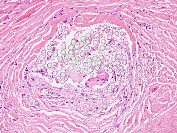 8A1 Foreign Body Rxn, suture (Case 7) H&E 3 non-pol