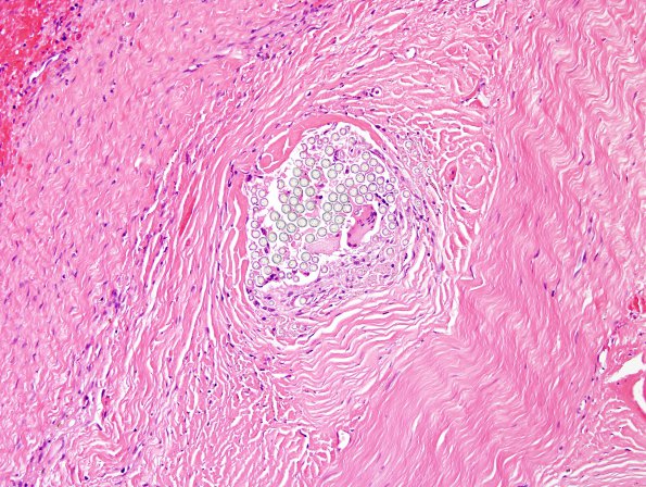 8A3 Foreign Body Rxn, suture (Case 7) H&E 4 non-polA