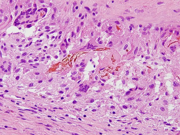 9 Giant cell foreign body reaction, hematoidin (Case 9) H&E 2