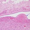 1A1 Ependymitis, granular (Case 1) H&E 1