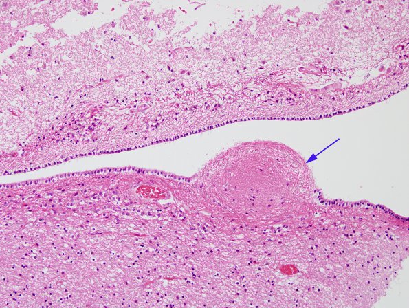 1A1 Ependymitis, granular (Case 1) H&E 1