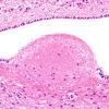 1A2 Ependymitis, granular (Case 1) H&E 2