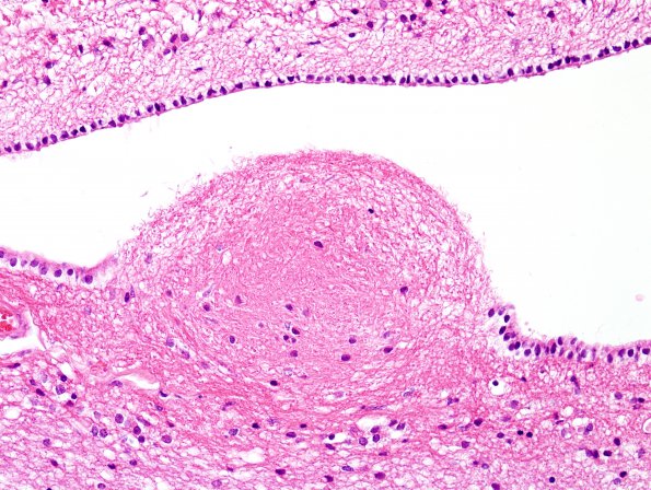 1A2 Ependymitis, granular (Case 1) H&E 2